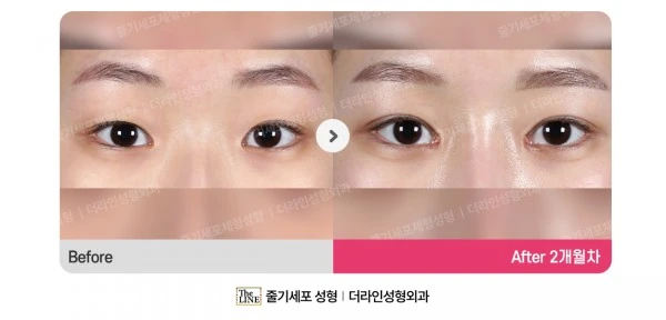 Eyelid Surgery, Non-Incisional Method before-and-after photo, before surgery - TheLINE Plastic Surgery