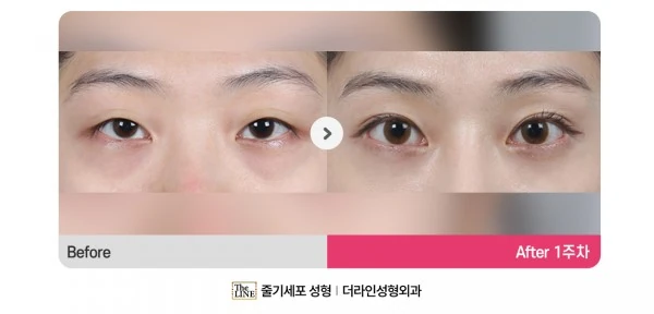 Incisional Double Eyelid Surgery, Epican before-and-after photo, before surgery - TheLINE Plastic Surgery