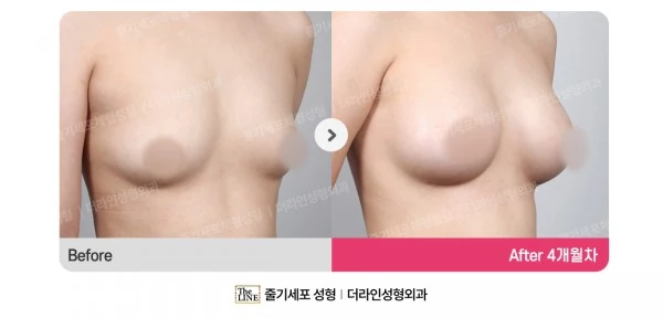 Breast Implant before-and-after photo, before surgery - TheLINE Plastic Surgery