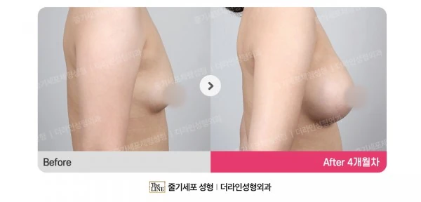 Breast Implant before-and-after photo, before surgery - TheLINE Plastic Surgery