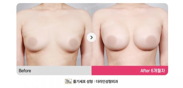 Breast Implant before-and-after photo, before surgery - TheLINE Plastic Surgery
