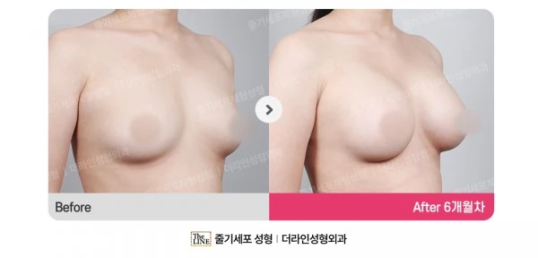 Breast Implant before-and-after photo, before surgery - TheLINE Plastic Surgery