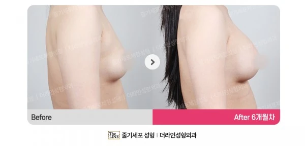 Breast Implant before-and-after photo, before surgery - TheLINE Plastic Surgery