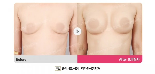 Breast Implant before-and-after photo, before surgery - TheLINE Plastic Surgery
