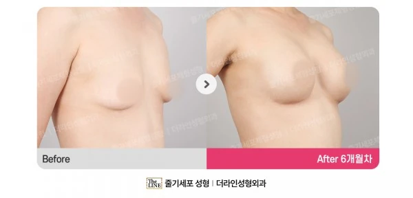 Breast Implant before-and-after photo, before surgery - TheLINE Plastic Surgery