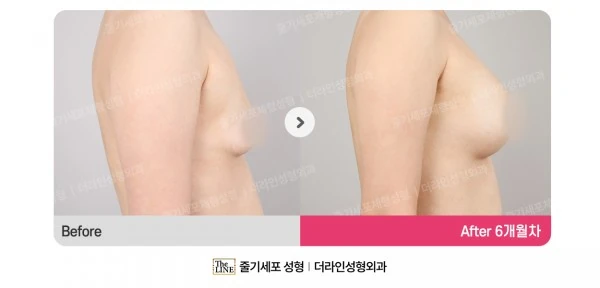 Breast Implant before-and-after photo, before surgery - TheLINE Plastic Surgery