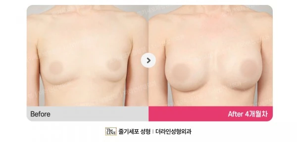 Breast Implant before-and-after photo, before surgery - TheLINE Plastic Surgery