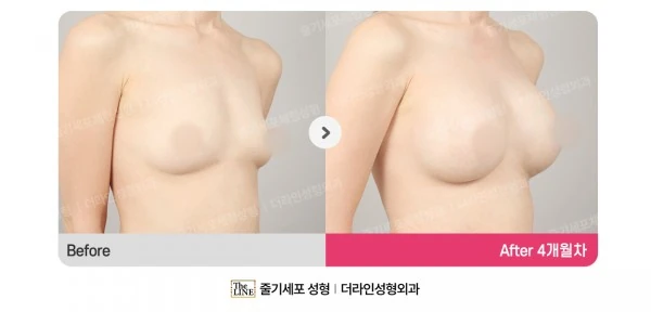 Breast Implant before-and-after photo, before surgery - TheLINE Plastic Surgery
