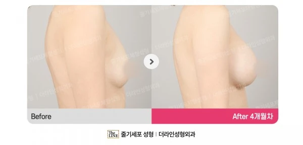 Breast Implant before-and-after photo, before surgery - TheLINE Plastic Surgery