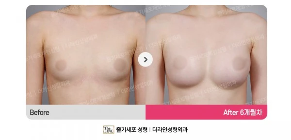 Breast Implant before-and-after photo, before surgery - TheLINE Plastic Surgery