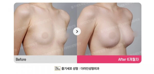 Breast Implant before-and-after photo, before surgery - TheLINE Plastic Surgery
