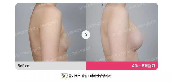 Breast Implant before-and-after photo, before surgery - TheLINE Plastic Surgery