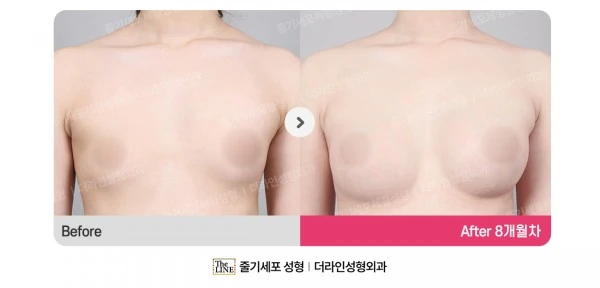 Breast Implant before-and-after photo, before surgery - TheLINE Plastic Surgery
