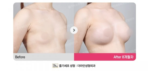 Breast Implant before-and-after photo, before surgery - TheLINE Plastic Surgery