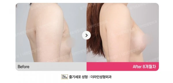 Breast Implant before-and-after photo, before surgery - TheLINE Plastic Surgery
