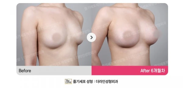 Breast Implant before-and-after photo, before surgery - TheLINE Plastic Surgery