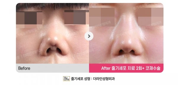 Stem Cell Revision Rhinoplasty, Stem Cel before-and-after photo, before surgery - TheLINE Plastic Surgery