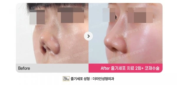 Stem Cell Revision Rhinoplasty, Stem Cel before-and-after photo, before surgery - TheLINE Plastic Surgery