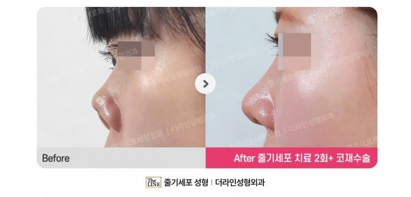 Stem Cell Revision Rhinoplasty, Stem Cel before-and-after photo, before surgery - TheLINE Plastic Surgery