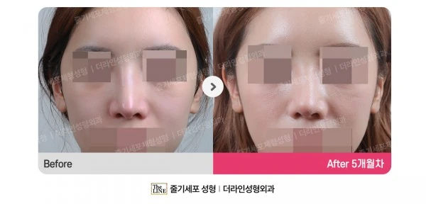 Revision Rhinoplasty before-and-after photo, before surgery - TheLINE Plastic Surgery
