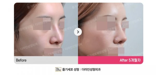 Revision Rhinoplasty before-and-after photo, before surgery - TheLINE Plastic Surgery