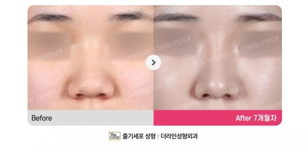 Barbie Nose, Rhinoplasty before-and-after photo, before surgery - TheLINE Plastic Surgery