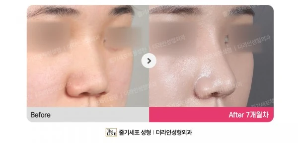 Barbie Nose, Rhinoplasty before-and-after photo, before surgery - TheLINE Plastic Surgery