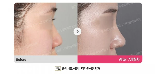 Barbie Nose, Rhinoplasty before-and-after photo, before surgery - TheLINE Plastic Surgery