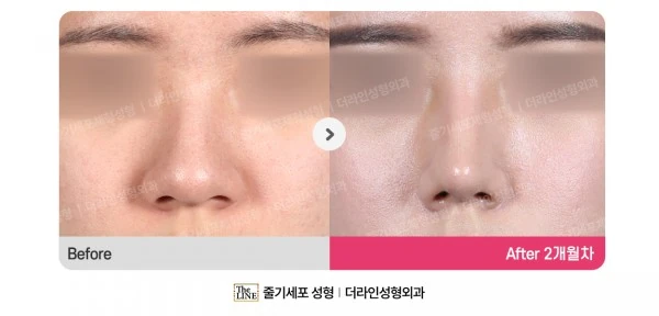 Hump Nose, Rhinoplasty before-and-after photo, before surgery - TheLINE Plastic Surgery
