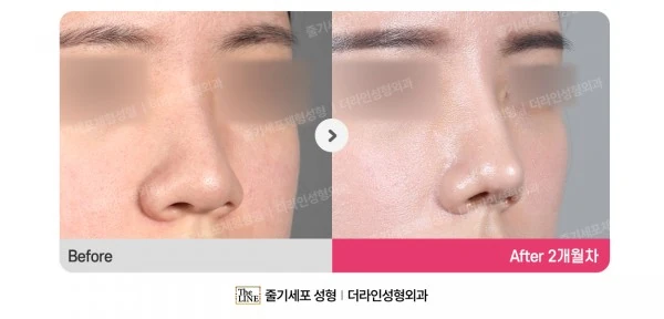 Hump Nose, Rhinoplasty before-and-after photo, before surgery - TheLINE Plastic Surgery