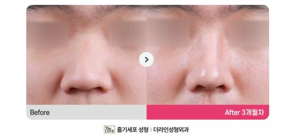 Deviated Nose, Rhinoplasty before-and-after photo, before surgery - TheLINE Plastic Surgery