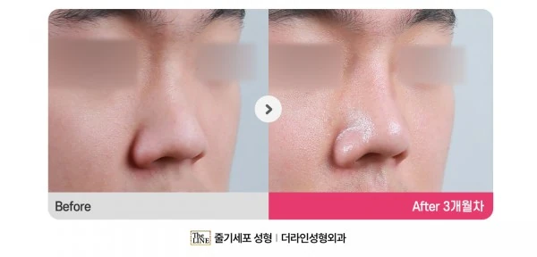 Deviated Nose, Rhinoplasty before-and-after photo, before surgery - TheLINE Plastic Surgery