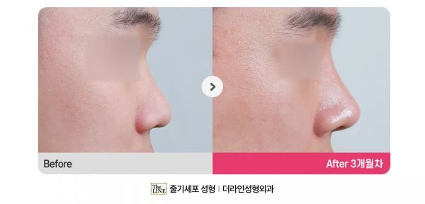 Deviated Nose, Rhinoplasty before-and-after photo, before surgery - TheLINE Plastic Surgery
