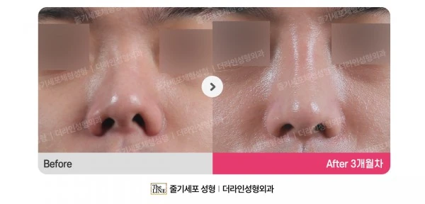 Revision Rhinoplasty before-and-after photo, before surgery - TheLINE Plastic Surgery