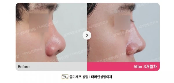 Revision Rhinoplasty before-and-after photo, before surgery - TheLINE Plastic Surgery