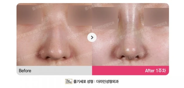 Barbie Nose, Rhinoplasty before-and-after photo, before surgery - TheLINE Plastic Surgery