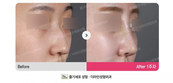 Barbie Nose, Rhinoplasty before-and-after photo, before surgery - TheLINE Plastic Surgery