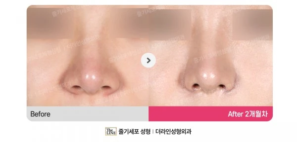 Alar Reduction, Rhinoplasty before-and-after photo, before surgery - TheLINE Plastic Surgery