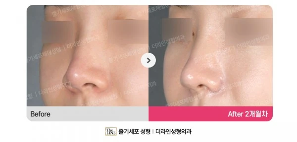 Alar Reduction, Rhinoplasty before-and-after photo, before surgery - TheLINE Plastic Surgery