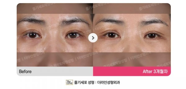 Under-Eye Fat Repositioning before-and-after photo, before surgery - TheLINE Plastic Surgery