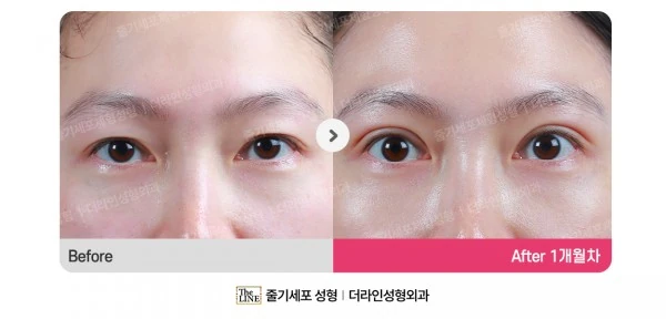 Incisional Double Eyelid Surgery, Ptosis before-and-after photo, before surgery - TheLINE Plastic Surgery