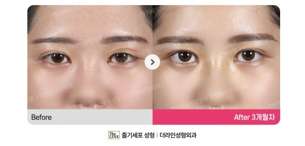 Ptosis Correction, Eyelid Revision Surge before-and-after photo, before surgery - TheLINE Plastic Surgery