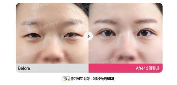 Non-Incisional Double Eyelid Surgery, Ep before-and-after photo, before surgery - TheLINE Plastic Surgery