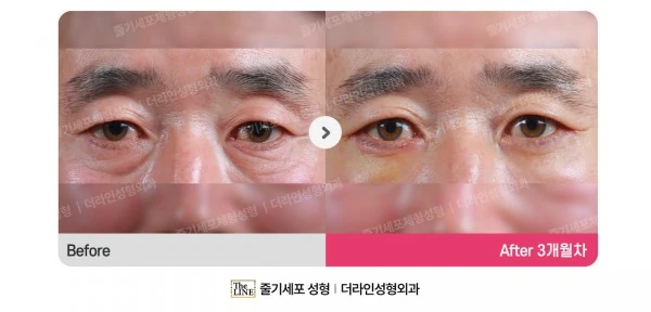 Lower Blepharoplasty before-and-after photo, before surgery - TheLINE Plastic Surgery