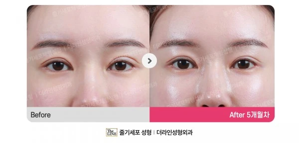 Eyelid Revision Surgery before-and-after photo, before surgery - TheLINE Plastic Surgery