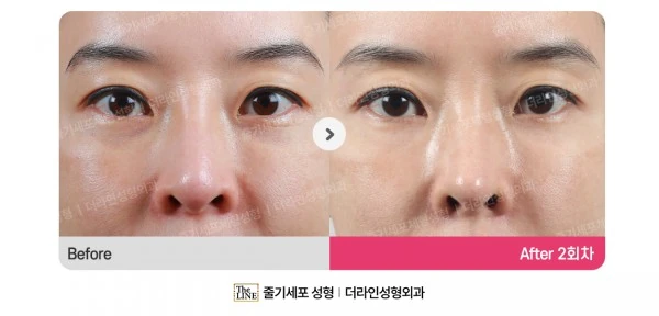Stem Cell Under-Eye Fat Grafting before-and-after photo, before surgery - TheLINE Plastic Surgery