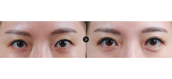 Non-Incisional Double Eyelid Surgery before-and-after photo, before surgery - TheLINE Plastic Surgery