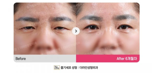Upper Blepharoplasty before-and-after photo, before surgery - TheLINE Plastic Surgery