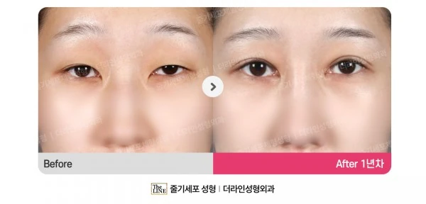 Ptosis Correction, Incisional Double Eye before-and-after photo, before surgery - TheLINE Plastic Surgery
