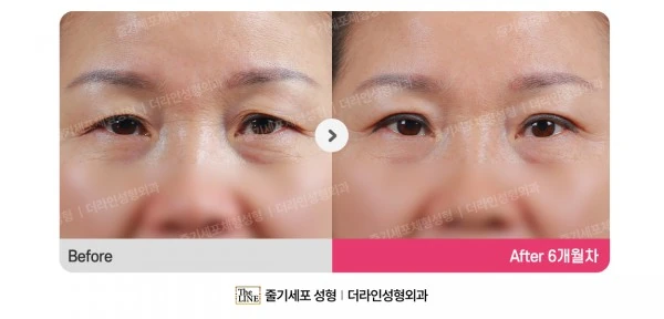 Upper Blepharoplasty before-and-after photo, before surgery - TheLINE Plastic Surgery